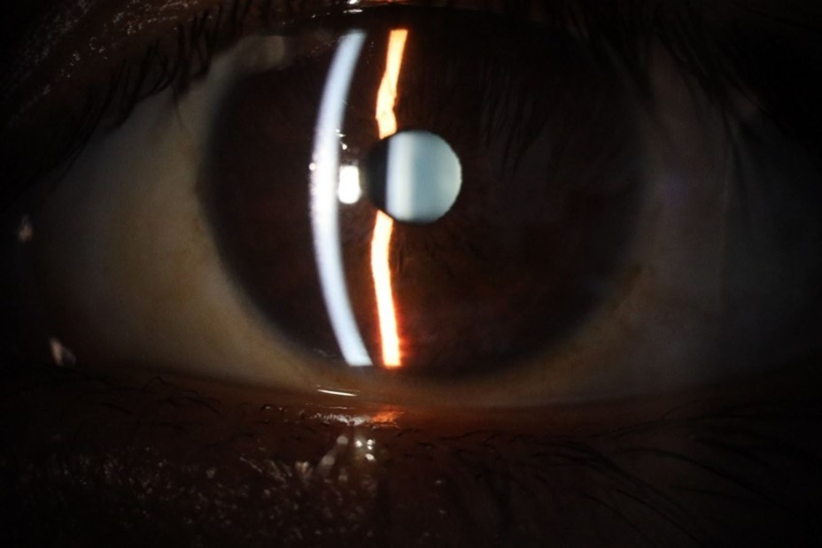 The transparent media of the left eye does not show any alteration.