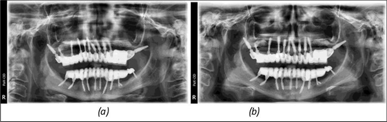 Rx panoramic final situation control: (a) Panoramic X-ray with the addition of a distal BCS implant in quadrant 3 at 11.2022; (b) Control X-ray, 10.2023.