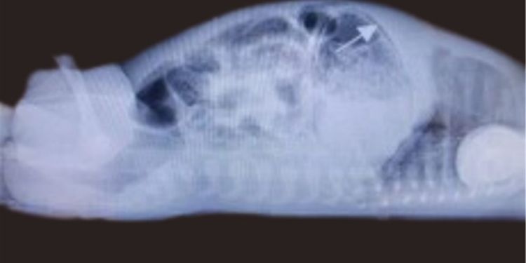 Article: Gastric Pneumatosis: the tale of two late preterm infants with Necrotizing Enterocolitis